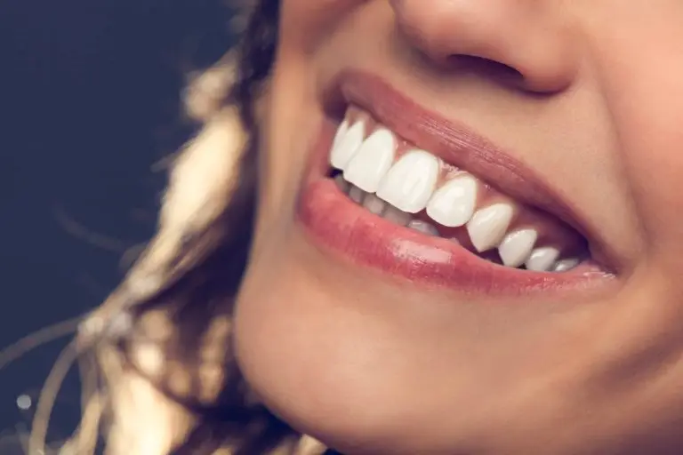 Dental Veneers