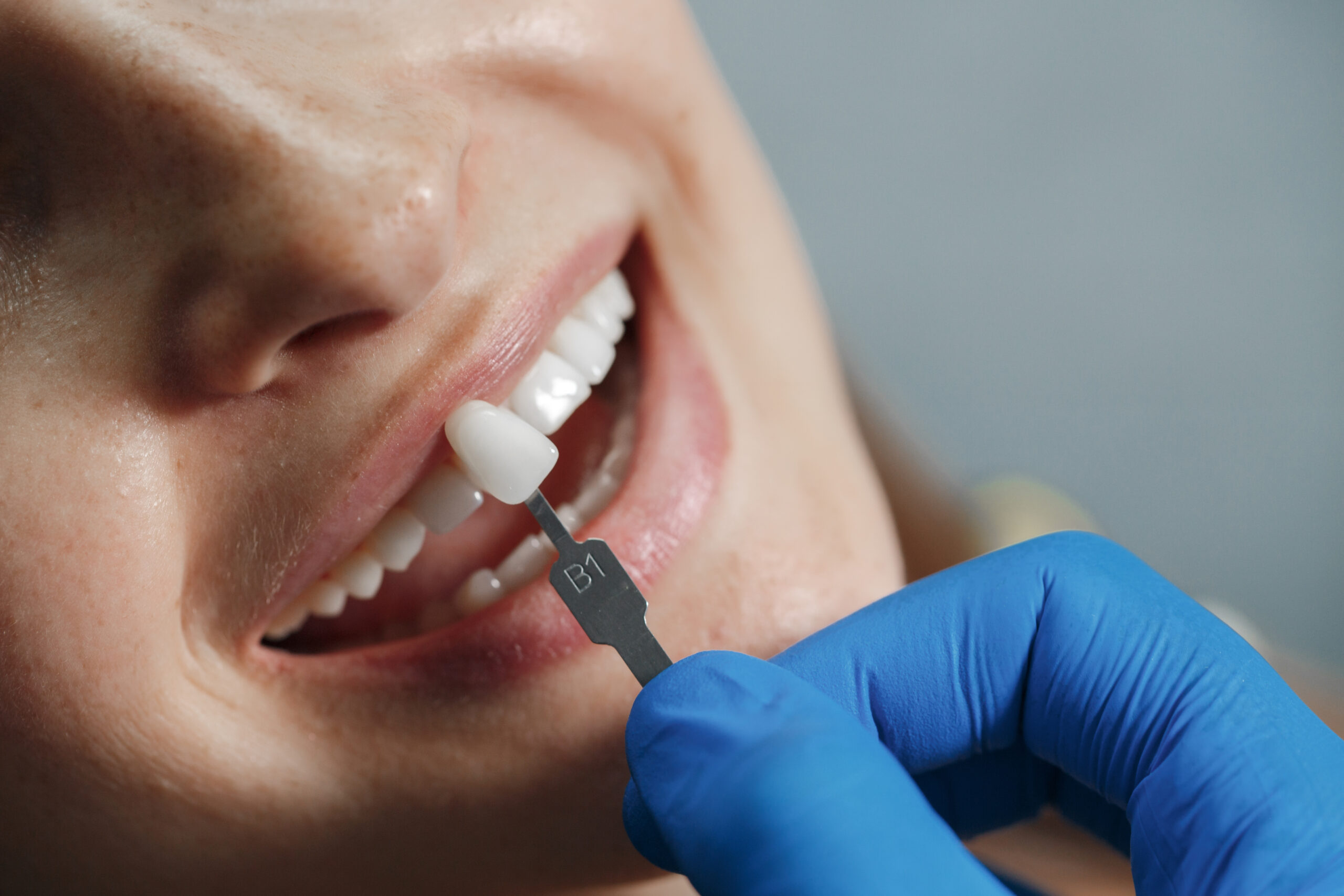 Smile Makeover with Dental Implants: Restore Your Confidence Today