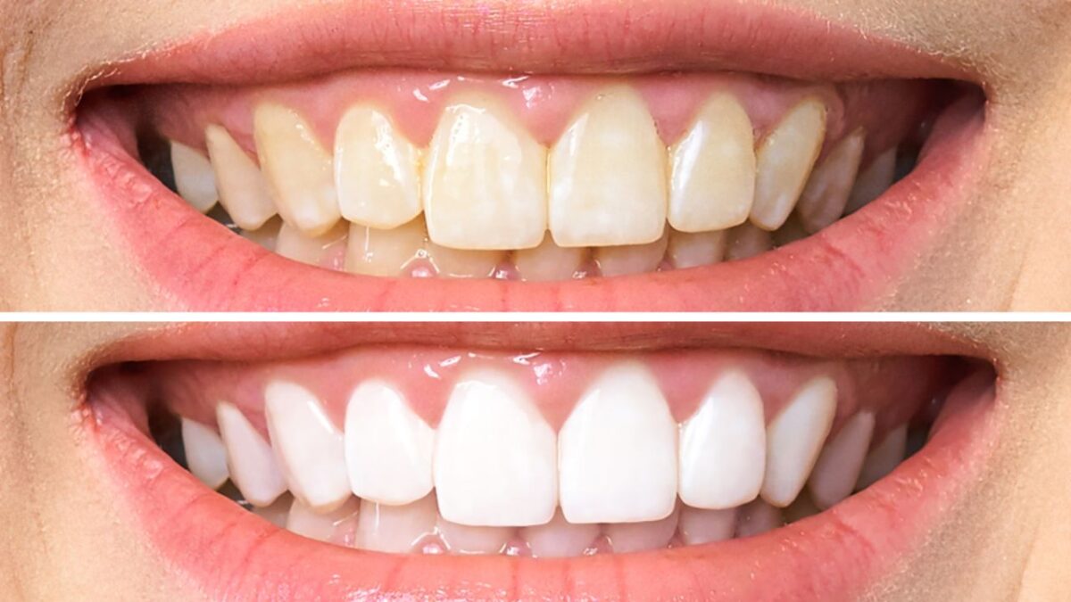 Teeth Whitening: Laser vs. LED Kits Compared