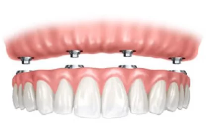 dental-implant-surgery-digital-all-on-x