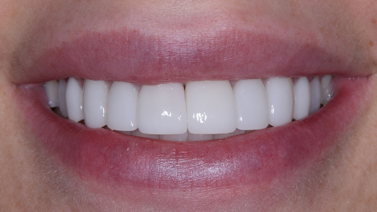Dental Veneers