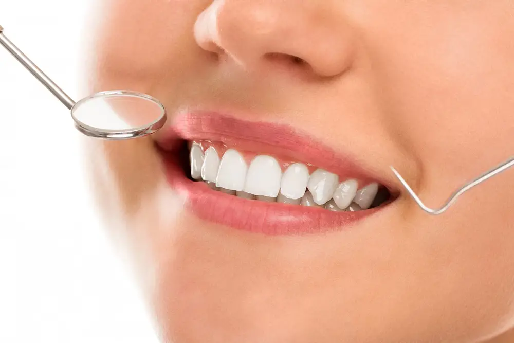 dental veneers