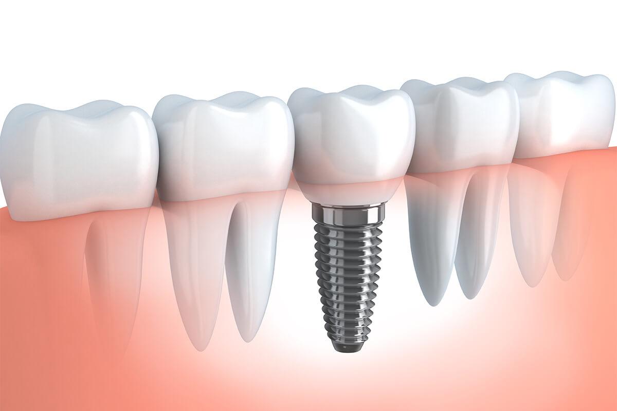 Two-Tooth Implants